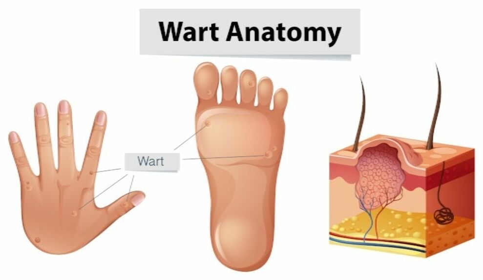 Successful removal of warts as well as the root using Removio