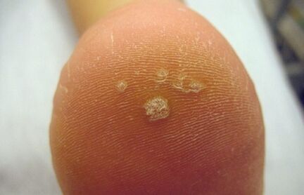 How to recognize a permanent wart
