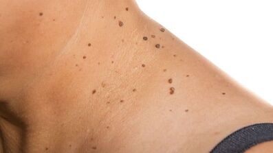 How to get rid of the papillom around the neck