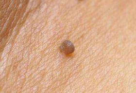 Clinical photo of the papilloma