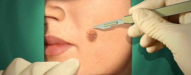 Papillom surgical treatment