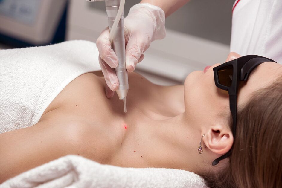 Elimination of papilloma laser