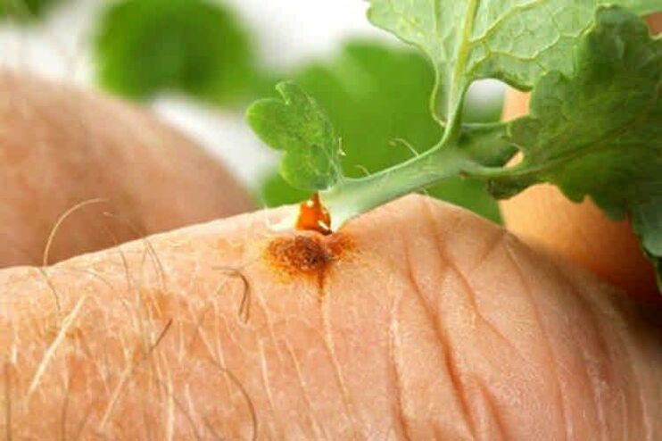 How to remove papillomas with folk remedies