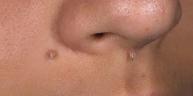 The reasons for the appearance of papillomas
