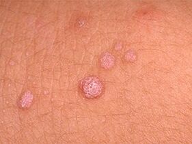how to get rid of papillomas on the body