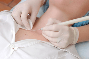ways to remove papillomas