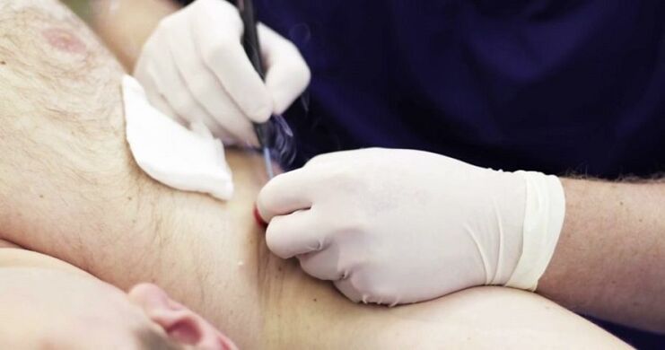 professional methods for removing papillomas on the human body