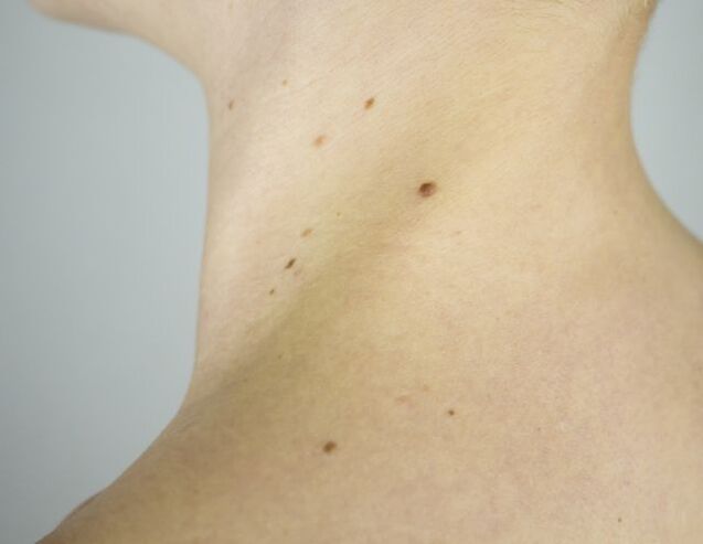 Papillomas on the neck of a girl