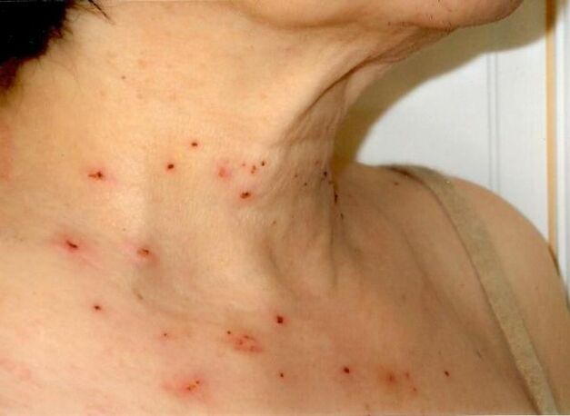 Results of treatment of papillomas of the neck