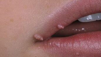 Papillomas on the lips