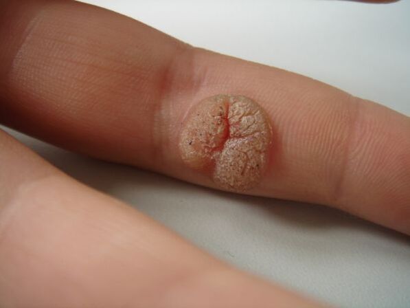 Complication of self-removal of papilloma