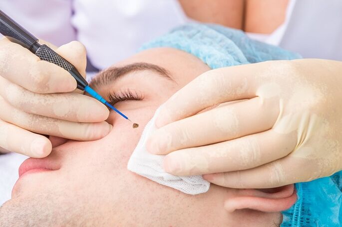 removal of facial papilloma due to human papilloma virus